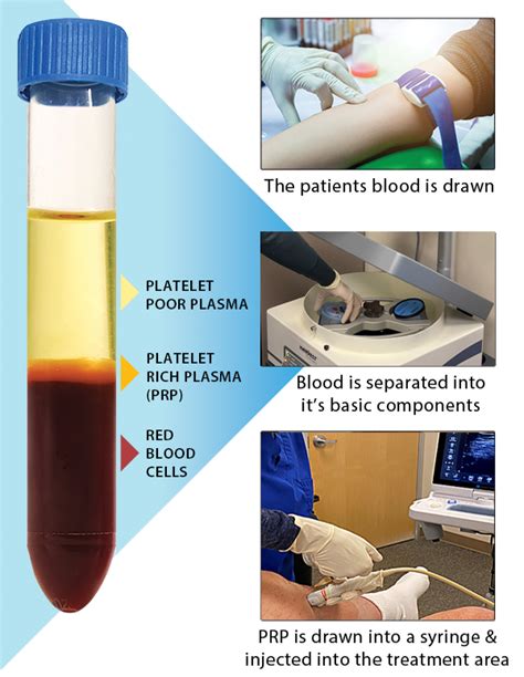 centrifuge prp|prp centrifuge method.